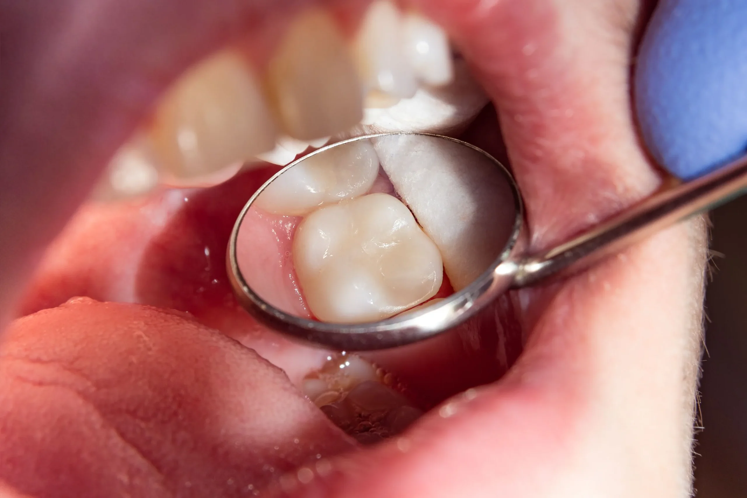 Trám răng khắc phục tình trạng mòn men răng