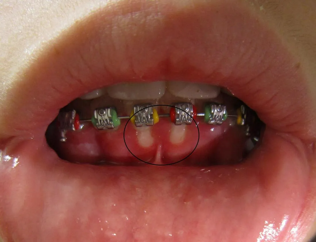 Sự ma sát giữa mắc cài và nướu răng gây nên những vết xước