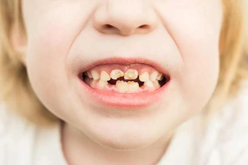 Trẻ bị sâu răng là một nguyên nhân gây nhiệt miệng