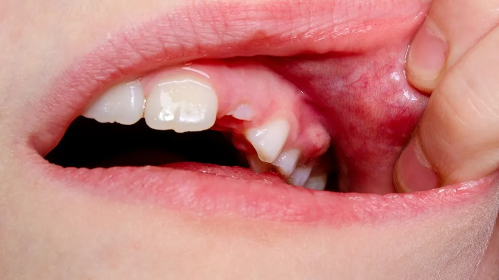 Các bệnh lý răng miệng khiến tình trạng hôi miệng ở trẻ trở nên phức tạp hơn