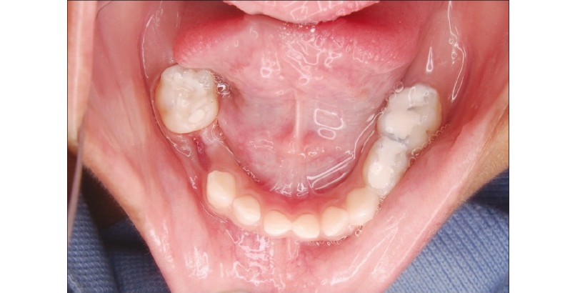 Sâu răng hàm quá nặng phải nhổ răng khiến bé bị mất răng hàm vĩnh viễn