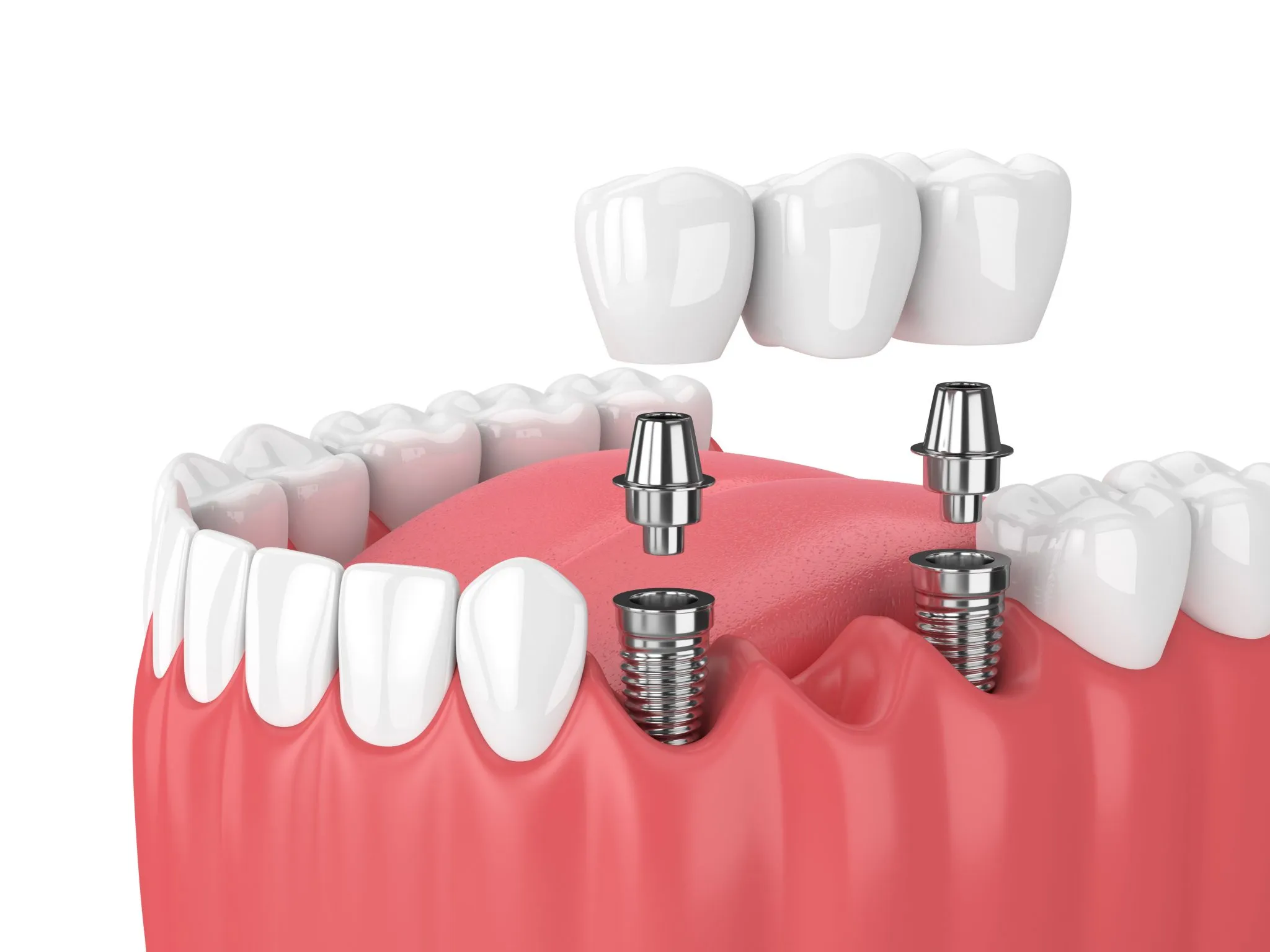 Nhổ răng và trồng răng implant