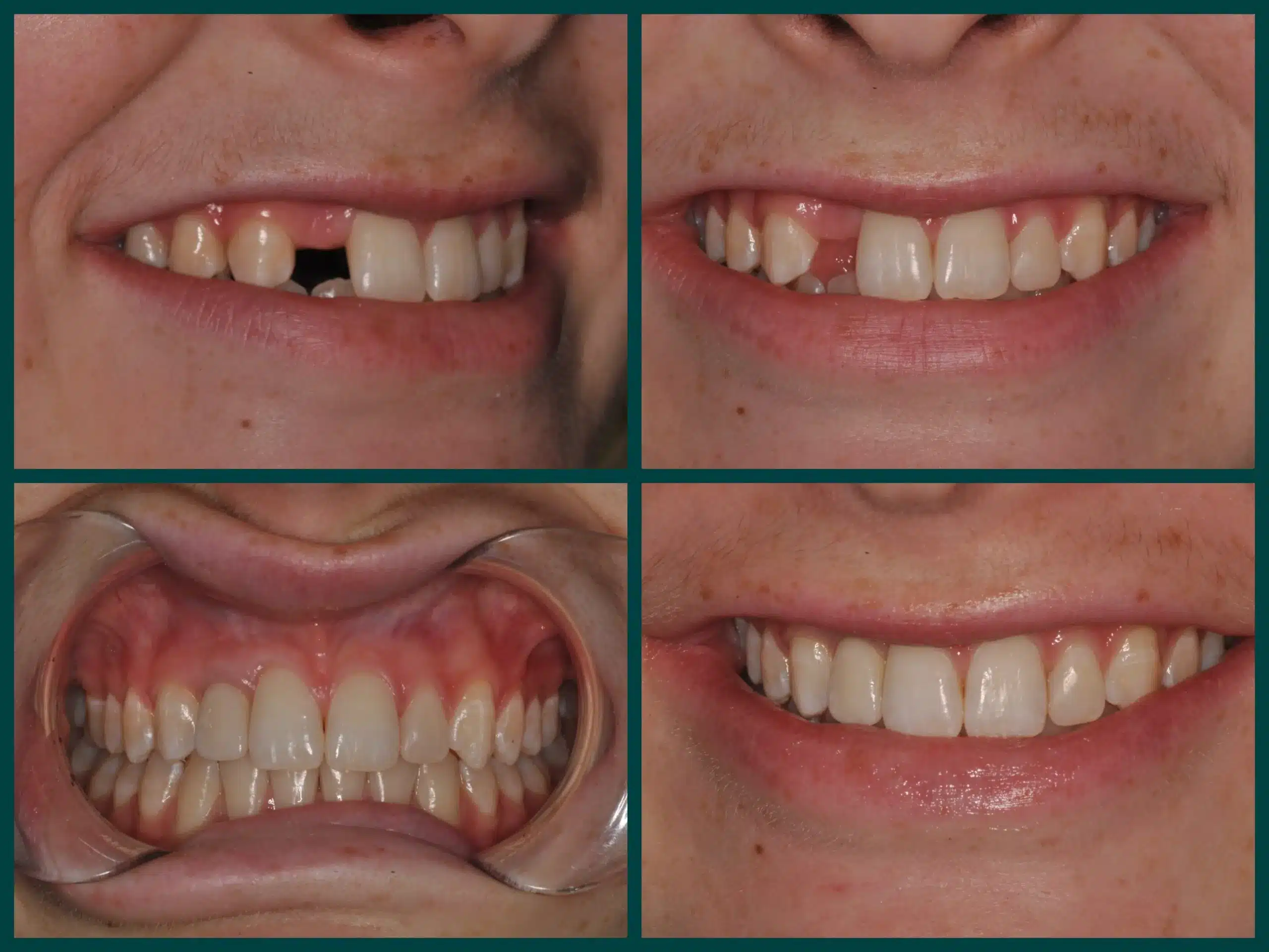 Phục hình răng khi bệnh nhân bị mất răng