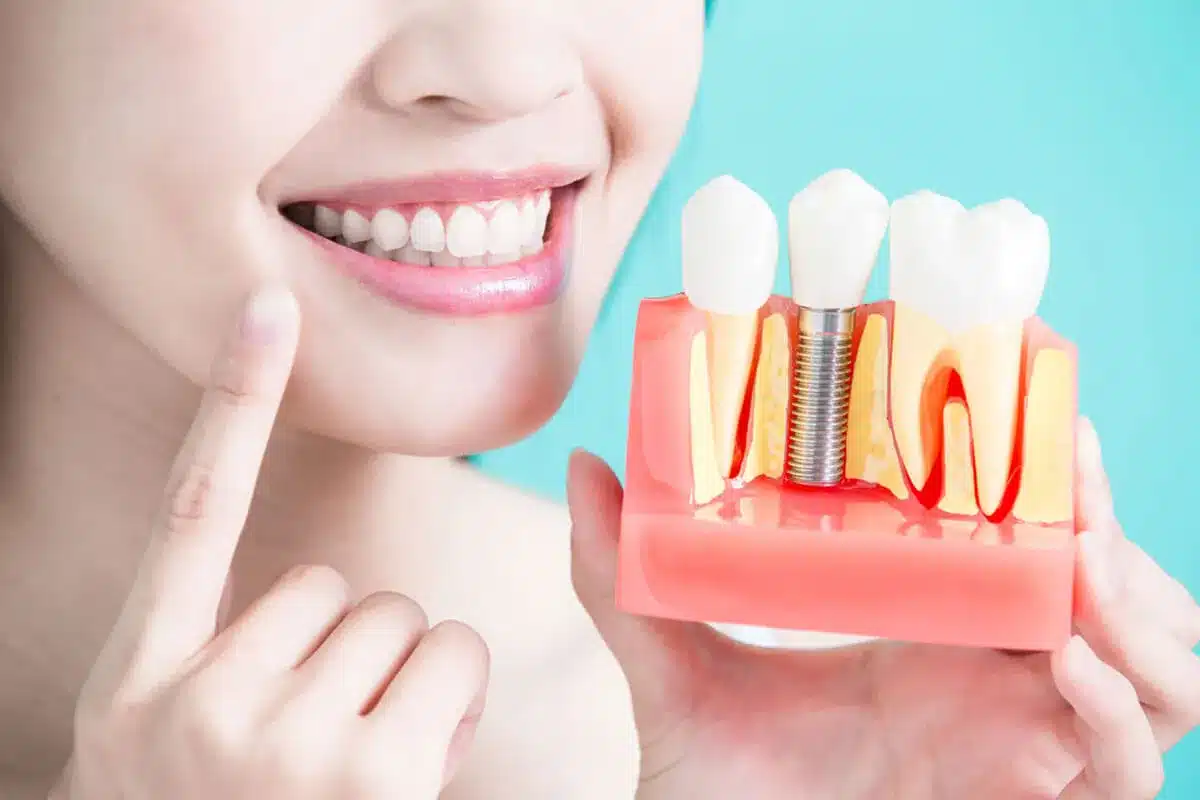 Trồng răng giả là phương pháp phục hình răng được nhiều người sử dụng