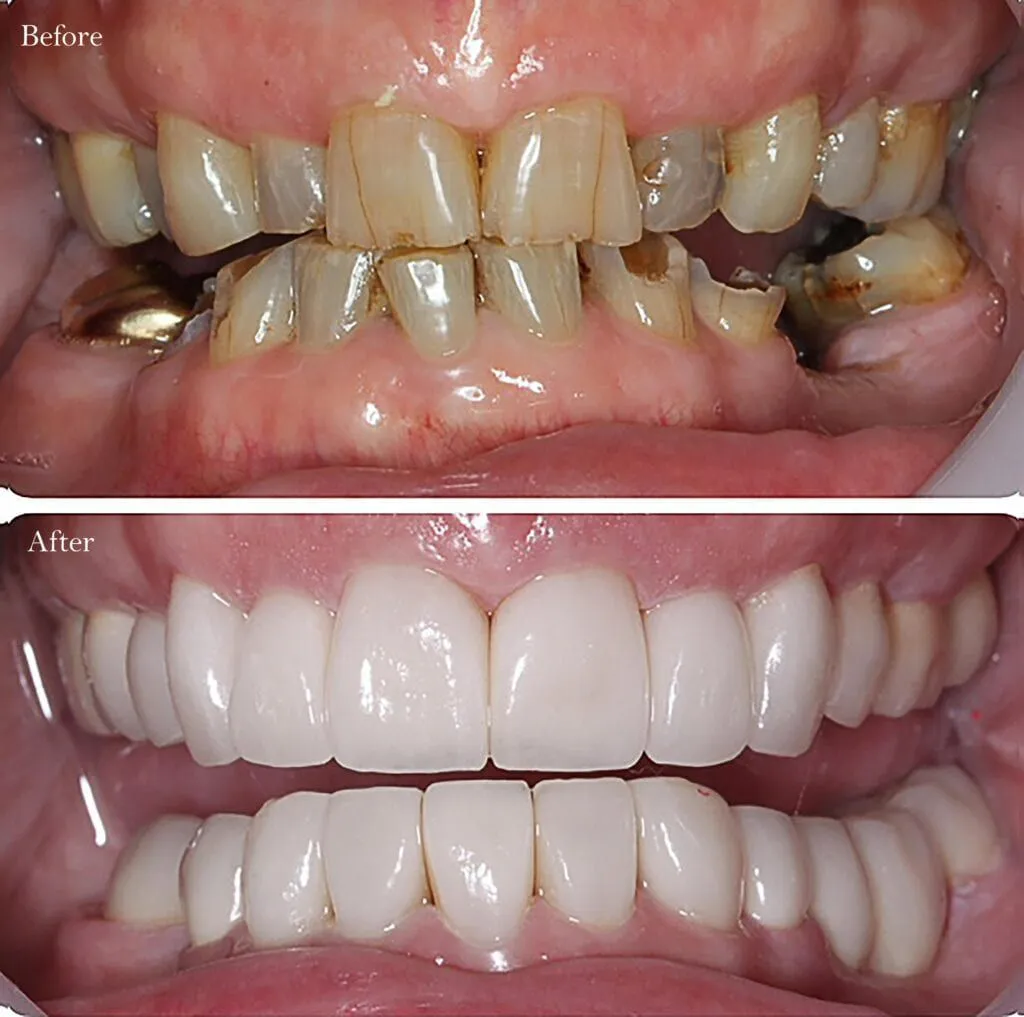 Trồng răng sứ để bảo tồn răng gốc cho bệnh nhân nếu bị sâu quá nặng