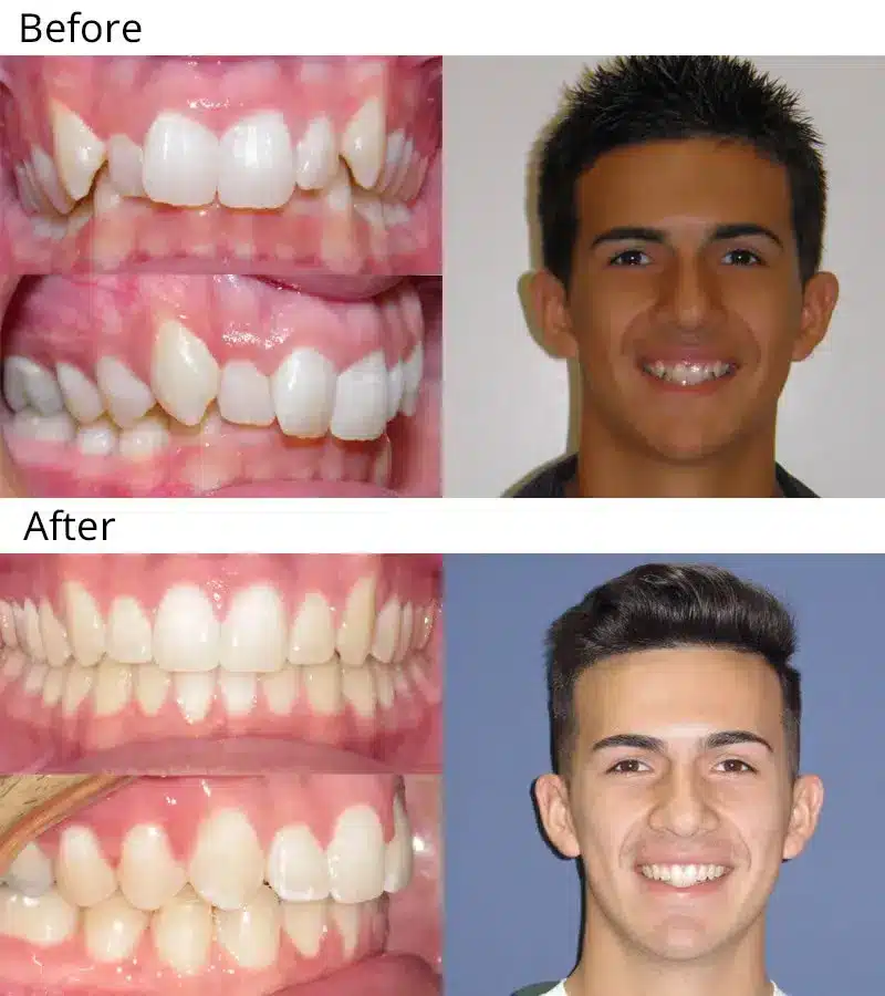 Niềng răng cho hiệu quả thẩm mỹ cao, mang lại nụ cười tự tin và cải thiện khả năng ăn nhai  