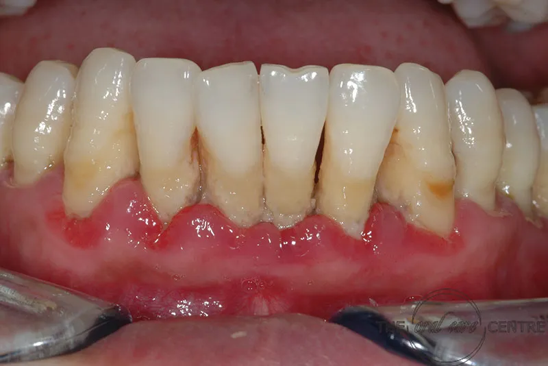 Biểu hiện của tụt nướu răng