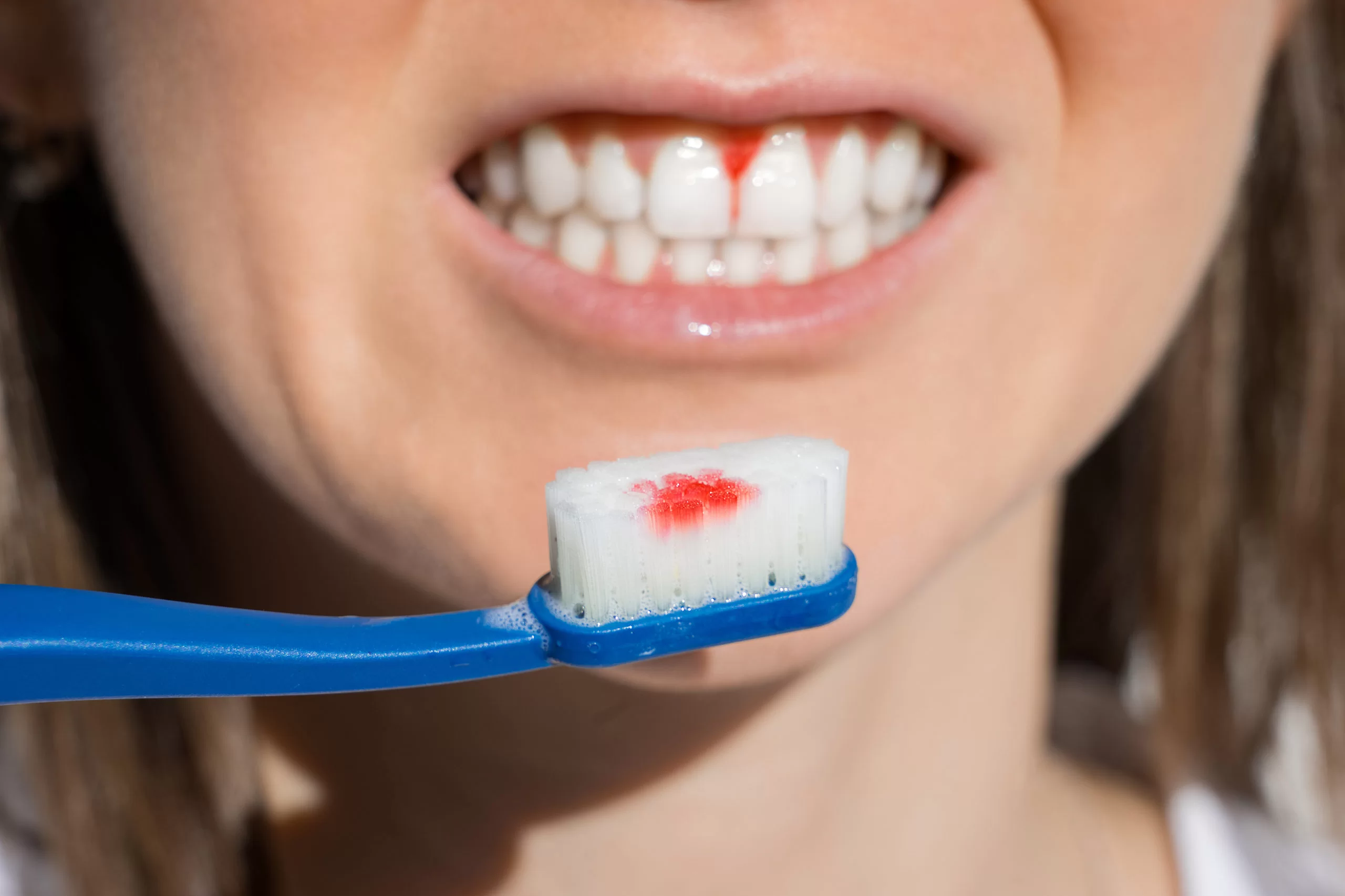 Vệ sinh răng miệng không đúng cách gây chảy máu chân răng