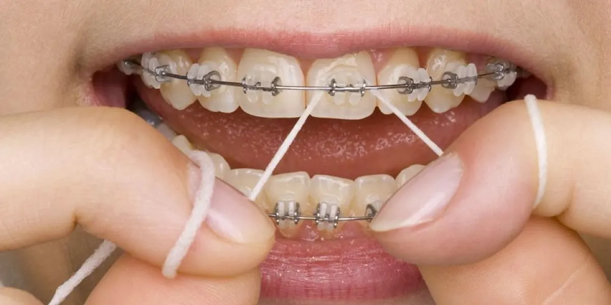 Vệ sinh răng miệng trước khi gắn sáp chỉnh nha