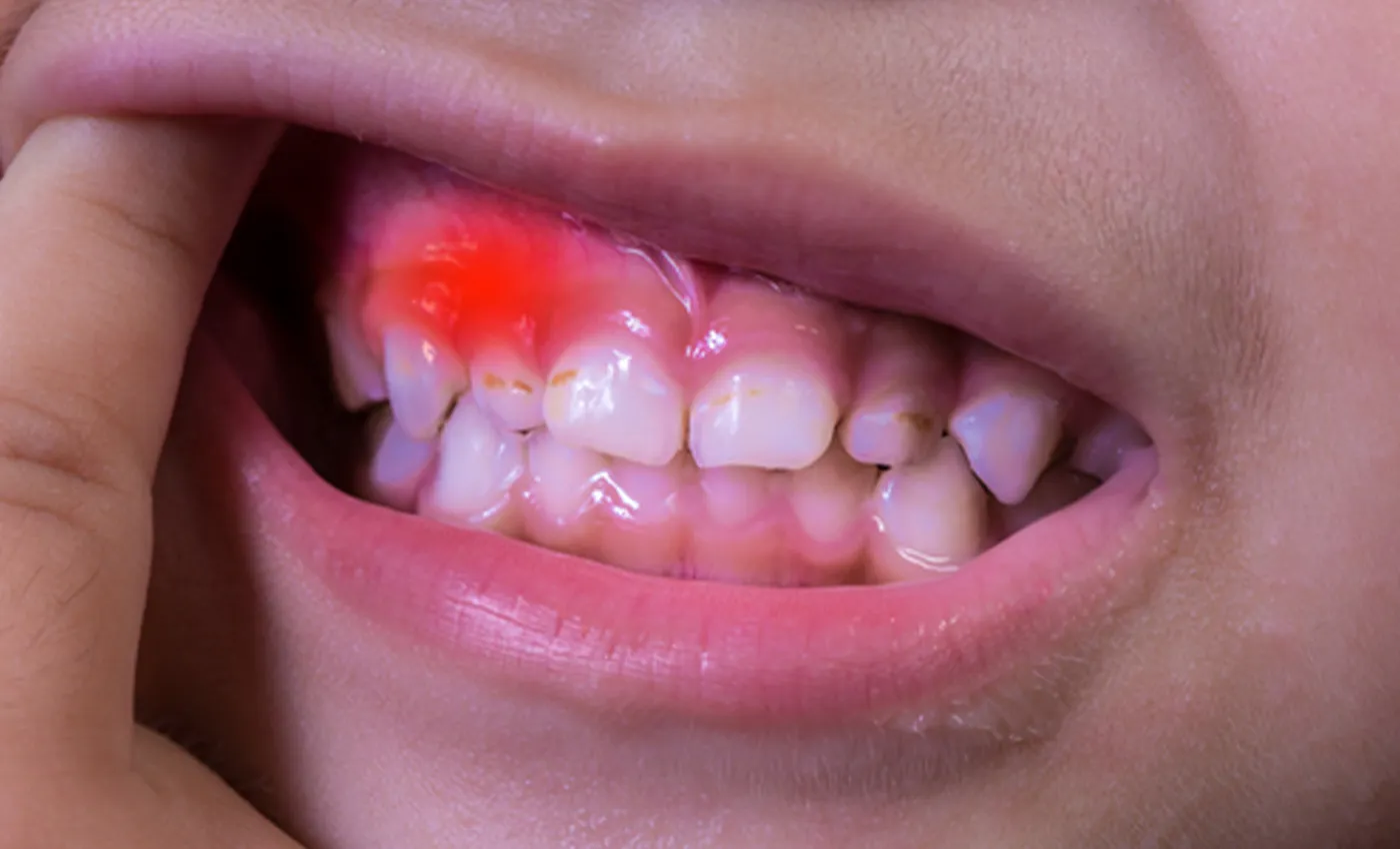 Viêm lợi là bệnh răng miệng phổ biến ở mọi độ tuổi