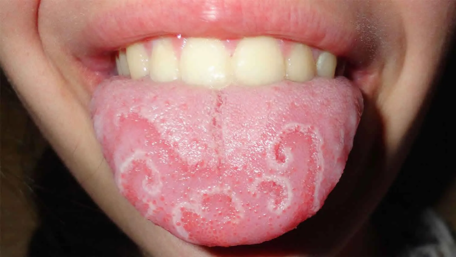 Viêm lưỡi là một bệnh lý nha khoa phổ biến gây hôi miệng cho bệnh nhân