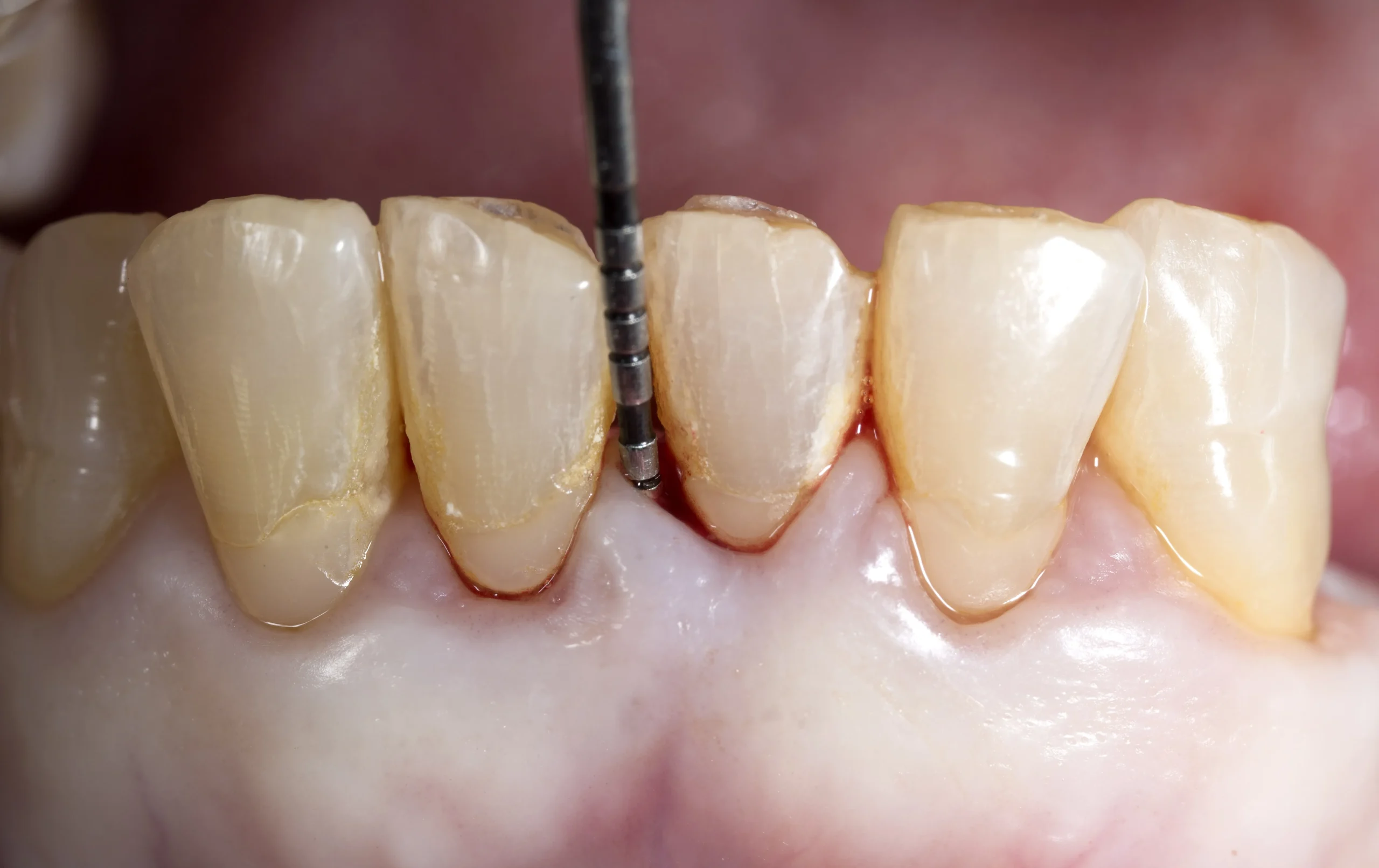 Viêm nha chu không điều trị kịp thời có thể gây chết tủy răng