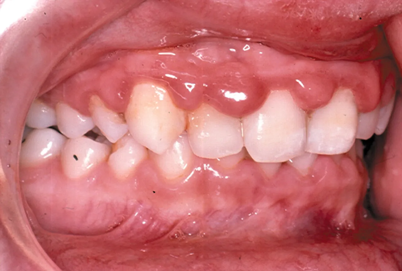 Ăn kẹo sâu răng ảnh hưởng đến nướu răng của trẻ