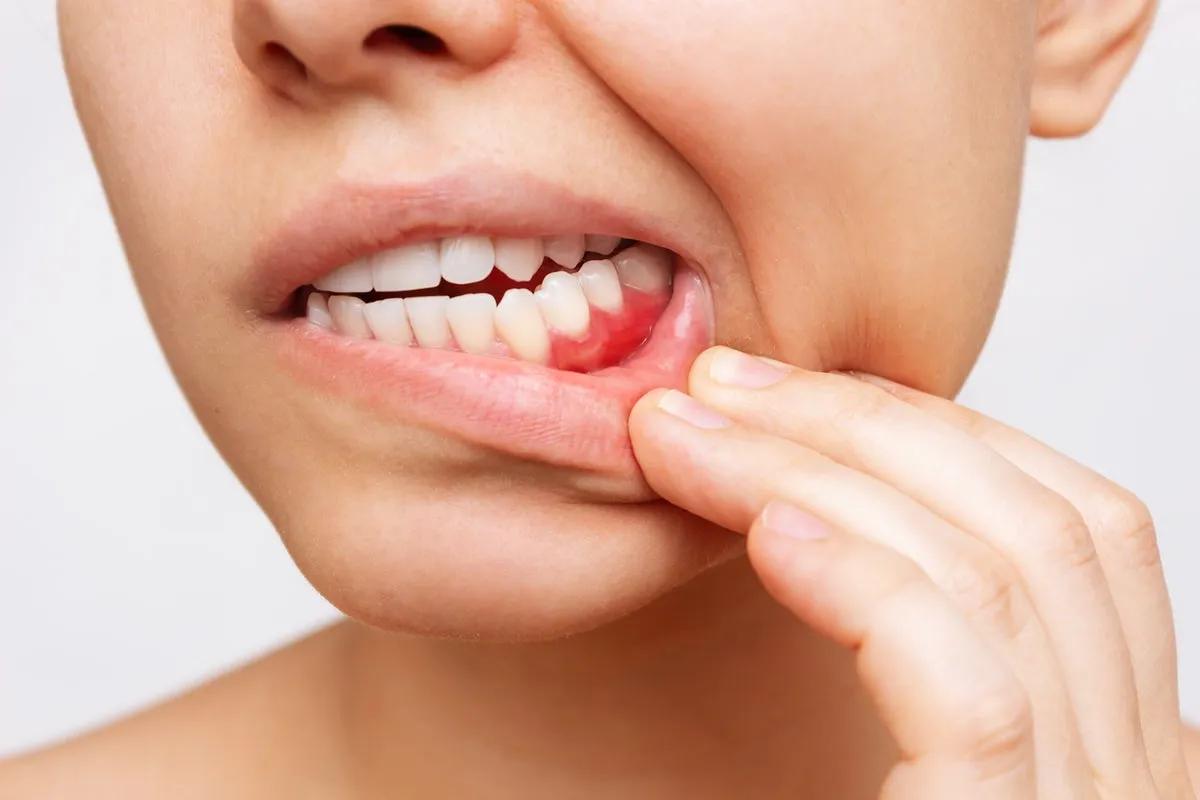 Viêm quanh răng tạo điều kiện cho vi khuẩn xâm nhập vào tủy