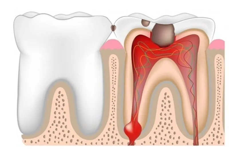 Viêm tủy răng là tình trạng tủy răng bị viêm nhiễm