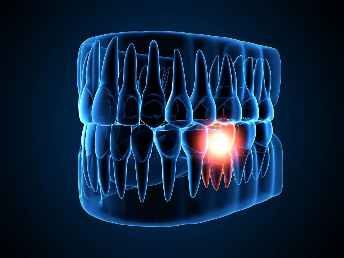 Viêm tủy răng mãn tính gây sưng viêm kéo dài