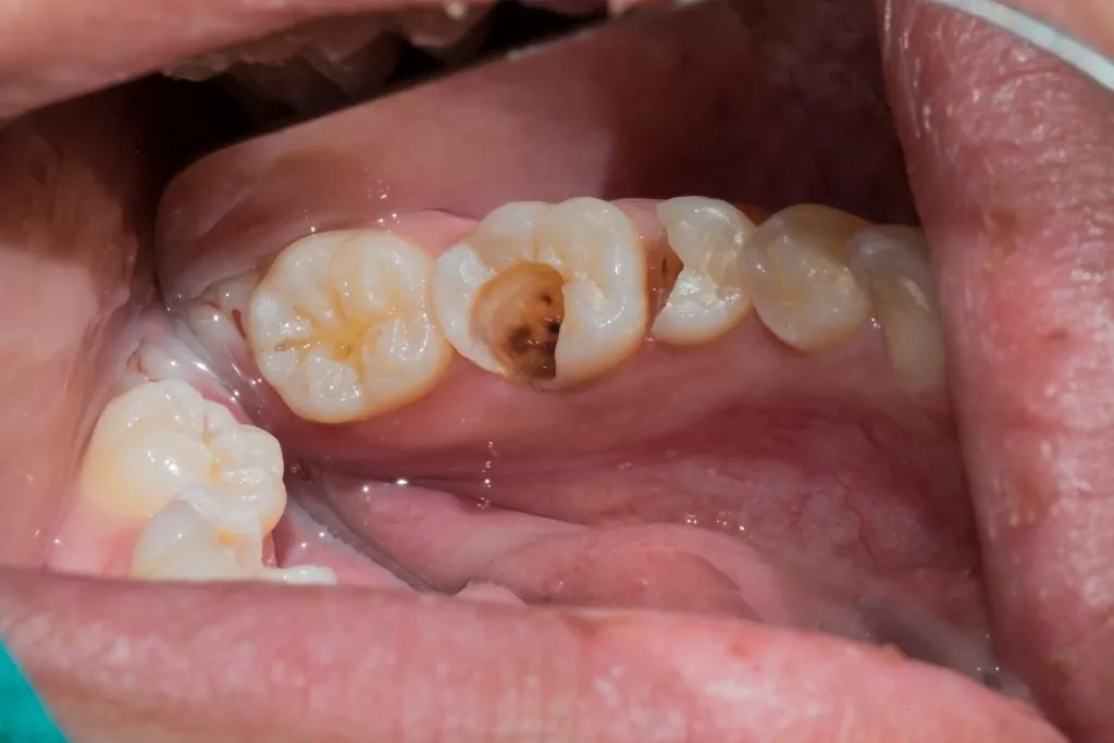 Xuất hiện lỗ sâu là dấu hiện sâu răng dễ thấy