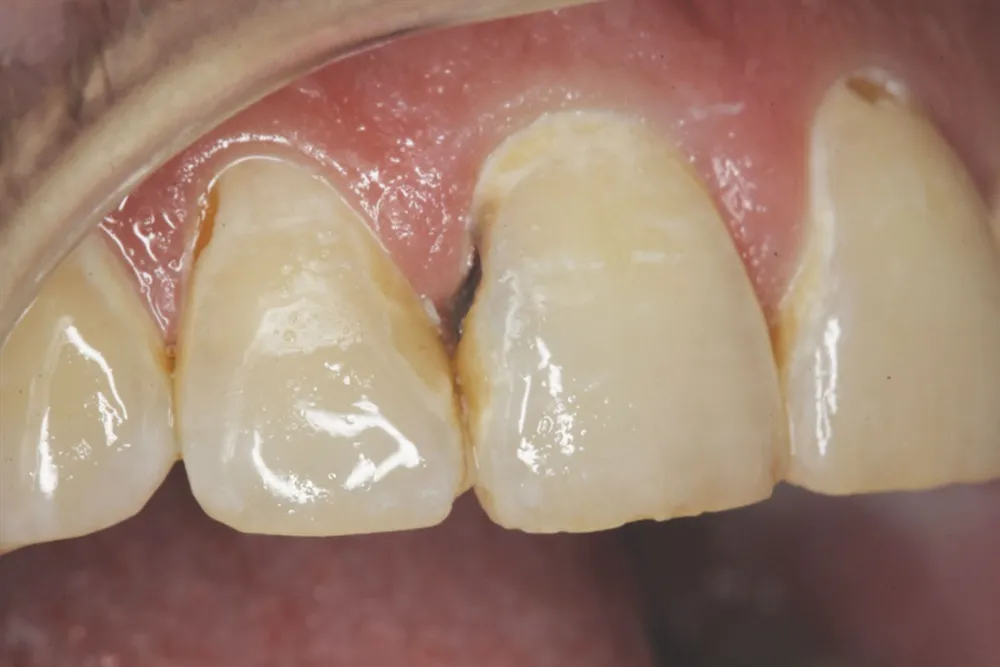 vết đen ở mặt tiếp xúc của răng